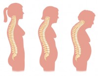 spinal_curve_osteoporosis