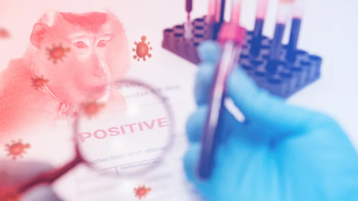 A magnifying glass that zooms in on information about monkeypox test positive results in a lab.