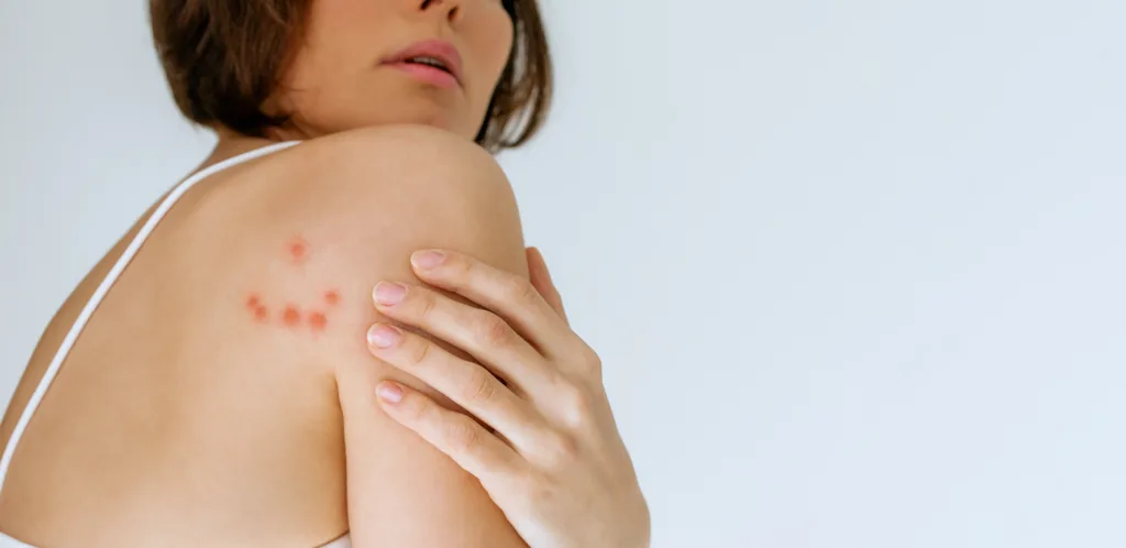 A woman scratches her shoulder bitten by a bedbug on a white background, close-up. Skin health problem. Red pimples.