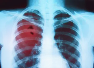 Rak pljuč: prvi bolnik prejel cepivo X-ray of the lungs of a sick person