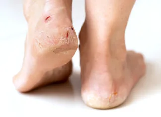 Naj razpokane pete postanejo stvar preteklosti! Female feet with cracked heels with small bleedings and wounds standing on a floor. Dehydrated problematic dry skin of feet.