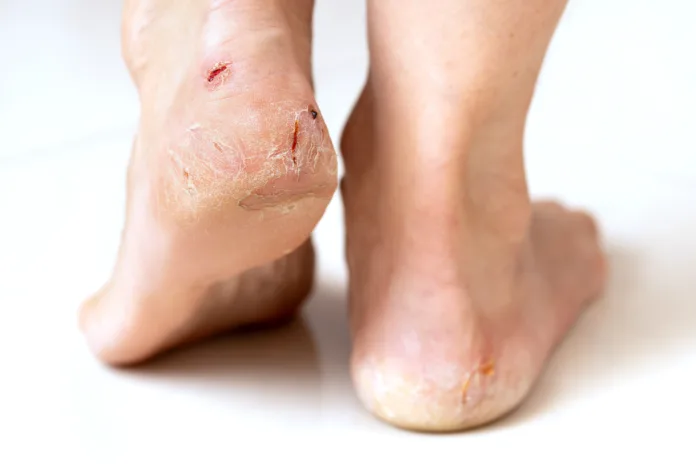 Female feet with cracked heels with small bleedings and wounds standing on a floor. Dehydrated problematic dry skin of feet.