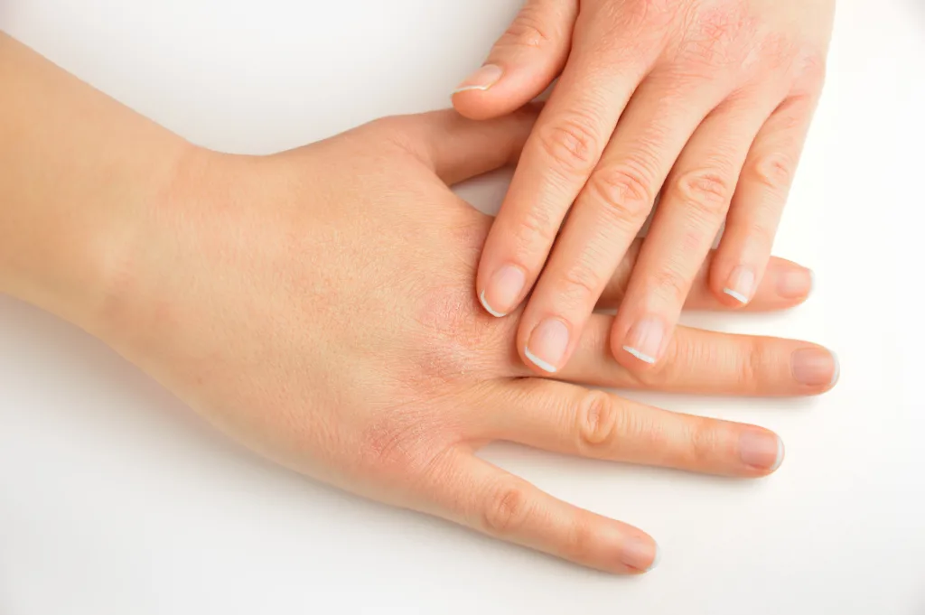 high angle view of hands touching with very dry skin and deep cracks on knuckles over white background