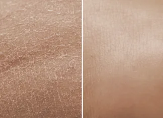 11 nasvetov za preprečevanje suhe kože pozimi Skin before and after a treatment with moisturizing cream. Concept of anti-aging products