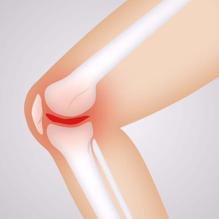 arthrocalman, osteoarthritis, knee, knee, knee, knee, knee, knee