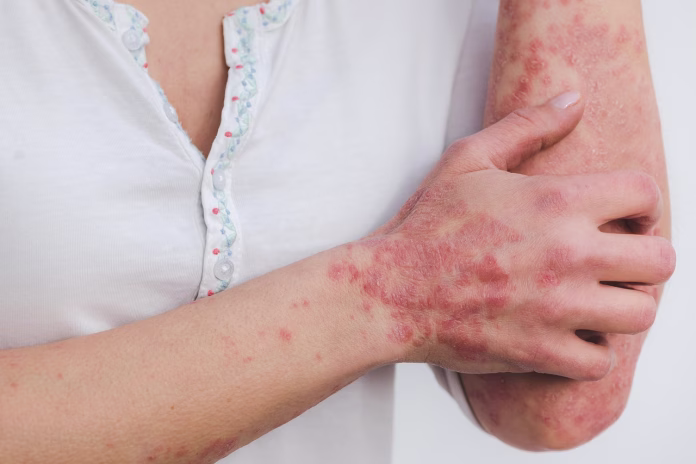 psoriasis-skin-disease-inflammation-scaly-skin-disease-red-inflamed-patient-stockpack-pixabay psoriasis, skin, disease, inflammation, scaly, skin disease, red, inflamed, patient, psoriasis, psoriasis, psoriasis, psoriasis, psoriasis, inflammation, skin disease, skin disease