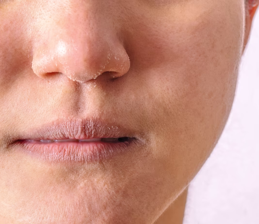 Razpokane ustnice: kako si pomagati na naraven način? Allergic women have eczema dry nose and lips on winter season closeup.