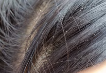 Ko na obisk ne pridejo samo vnuki, temveč tudi uši Louse egg on the hair causes itchy head.