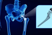 Po padcu starejše osebe bodite pozorni na te znake: lahko gre za zlom kolka Hip replacement implant installed in the pelvis bone. X-ray view. Medically accurate 3D illustration