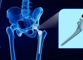 Po padcu starejše osebe bodite pozorni na te znake: lahko gre za zlom kolka Hip replacement implant installed in the pelvis bone. X-ray view. Medically accurate 3D illustration