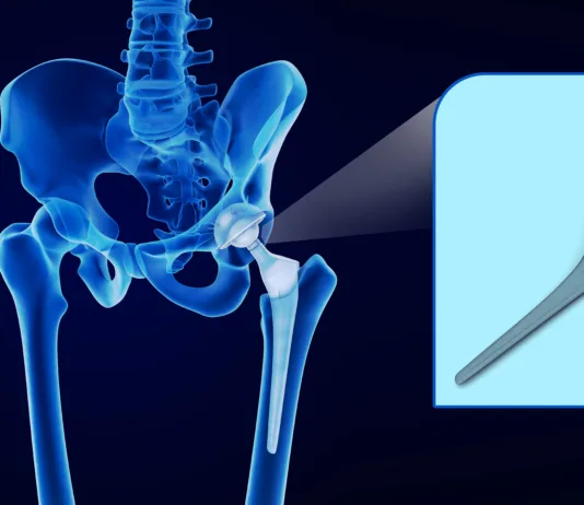 Po padcu starejše osebe bodite pozorni na te znake: lahko gre za zlom kolka Hip replacement implant installed in the pelvis bone. X-ray view. Medically accurate 3D illustration