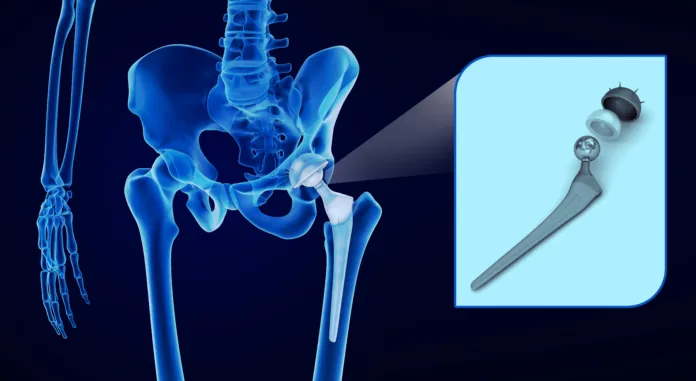 hip-replacement-implant-installed-in-the-pelvis-bone-x-ray-view-medically-accurate-3d-illustration-stockpack-istock Hip replacement implant installed in the pelvis bone. X-ray view. Medically accurate 3D illustration