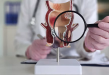 Hemeroidi: kaj so in kako si lahko pomagamo? Proctologist holds magnifying glass and anatomical model of rectum with hemorrhoids. Diseases of the rectum signs and diagnosis