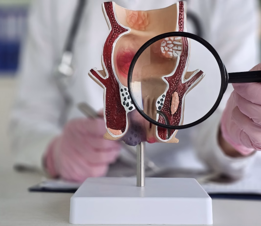 Hemeroidi: kaj so in kako si lahko pomagamo? Proctologist holds magnifying glass and anatomical model of rectum with hemorrhoids. Diseases of the rectum signs and diagnosis