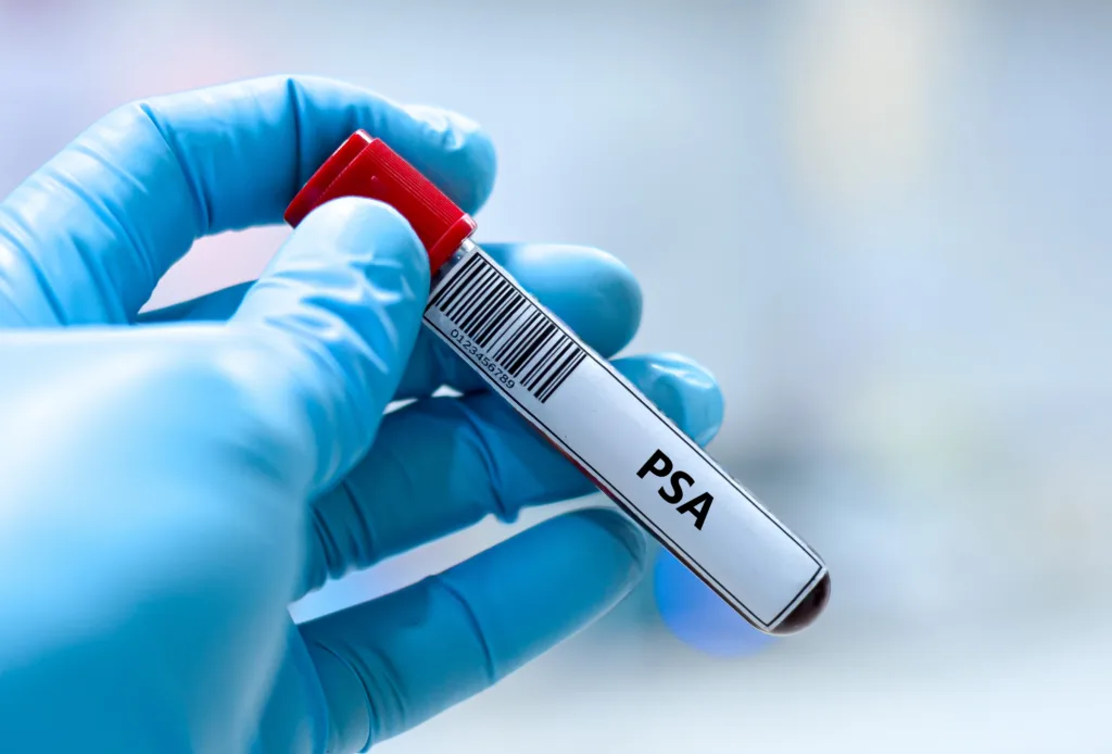 Blood sample tube for prostate specific antigen test analysis.