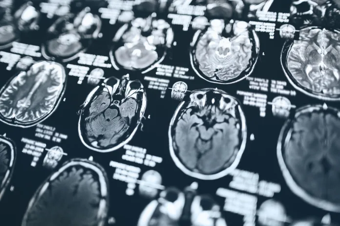 mri-head-scan-magnetic-resonance-imaging-of-head-stockpack-istock MRI head scan, magnetic resonance imaging of head.