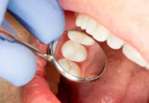 Od julija boste pri zobozdravniku prihranili denar two chewing side teeth of the upper jaw after treatment of caries. Restoration of the chewing surface with a photopolymer filling material using the Rubber Dam system