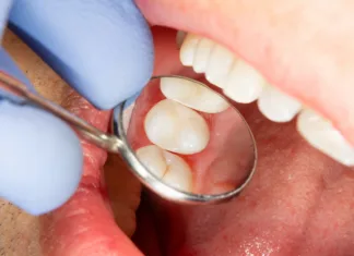 Od julija boste pri zobozdravniku prihranili denar two chewing side teeth of the upper jaw after treatment of caries. Restoration of the chewing surface with a photopolymer filling material using the Rubber Dam system