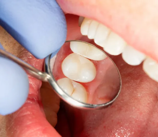Od julija boste pri zobozdravniku prihranili denar two chewing side teeth of the upper jaw after treatment of caries. Restoration of the chewing surface with a photopolymer filling material using the Rubber Dam system