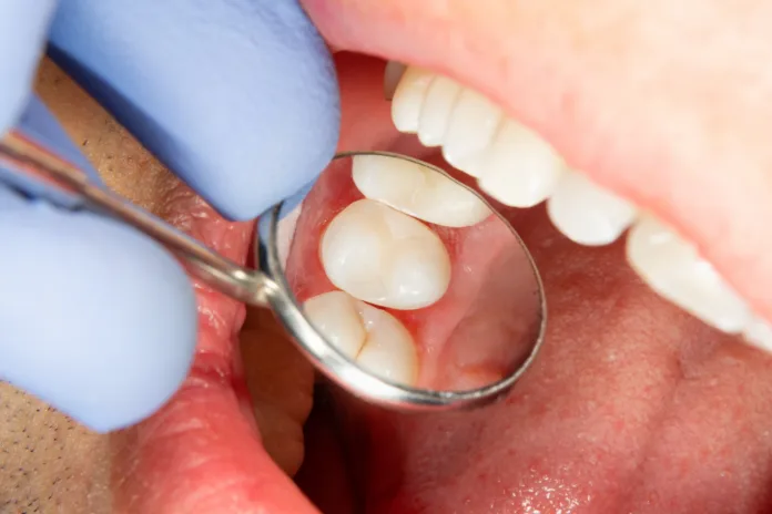 two-chewing-side-teeth-of-the-upper-jaw-after-treatment-of-caries-restoration-of-the-chewing-surface-with-a-photopolymer-filling-material-using-the-rubber-dam-system-stockpack-istock two chewing side teeth of the upper jaw after treatment of caries. Restoration of the chewing surface with a photopolymer filling material using the Rubber Dam system